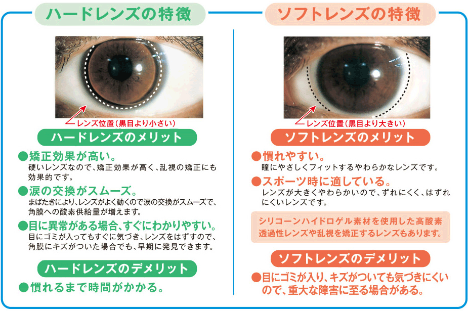 コンタクトレンズ 着用図